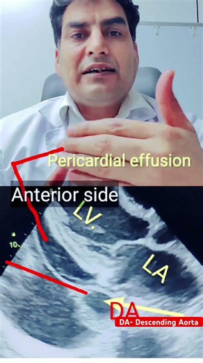 Pericardial V/s Pleural Effusion Echo 🩸l #echo #effusion #shorts