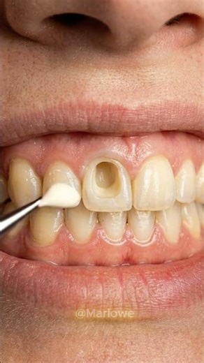 Extreme Cavity Cleaning & Tooth Filling! 🦷 | Satisfying Dental ASMR