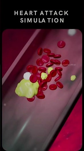 Heart Attack Online Simulation - 3D Animation