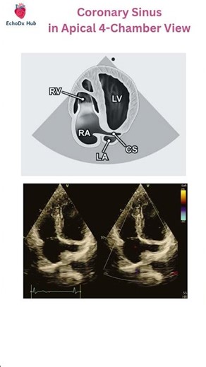 Coronary Sinus in Apical 4-Chamber View #EchoDxHub #CoronarySinus #A4C