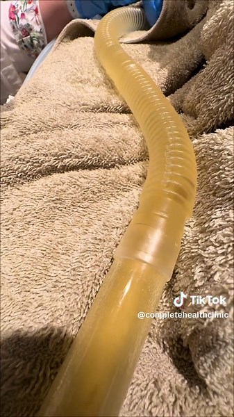 Improving Gut Health with Colonic Irrigation - Detox and Relieve Bloating