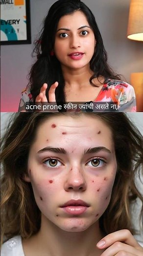 चेहऱ्यावरील मुरूम व पुळ्या जाण्यासाठी उत्तम उपाय | Best acne prone skin solution