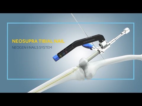 Kanghui NeoSupra | Proximal Tibial Nailing System