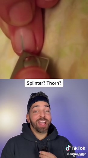 How did it get there?!? #dermdoctor #splinter #pimplepopping