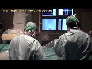 New BPH treatment: Prostate arteries embolization