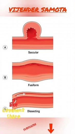 Types of aneurysm. A. Saccular B. Fusiform C. Dissecting