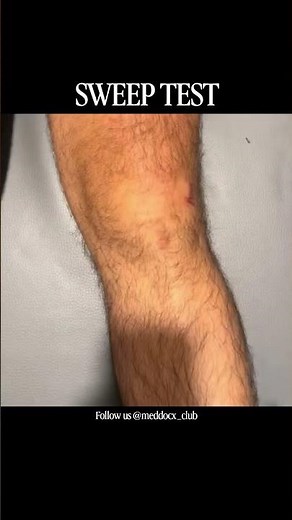 SWEEP TEST ( BULGE SIGN ) #kneepain #kneejoint # #medicalschoolcommunity