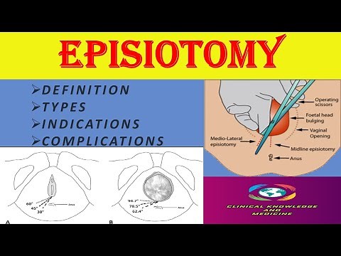 Episiotomy- Definition, Indications, Types, Complications