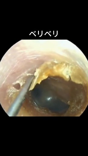 Relaxing Ear Cleaning Video