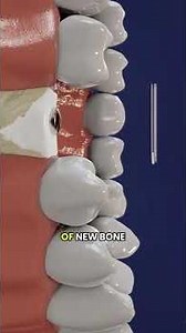 Dental Bone Graft Surgery Explained 🔍 | #dentistry #oralurgery #medicalshorts