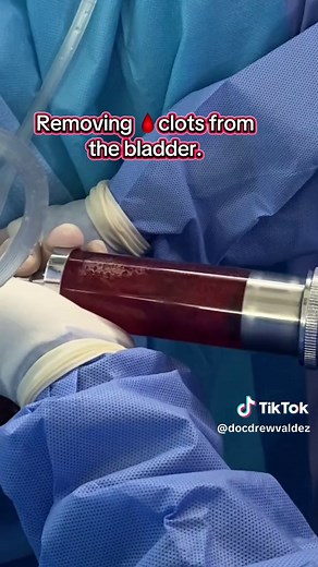 Removing Blood Clots from the Bladder: A How-To Guide