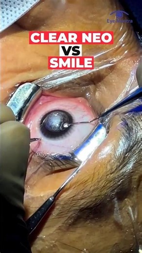 Clear Neo vs SMILE: Which Eye Surgery is Better?