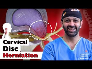 Cervical Disc Herniation Explained: Causes, Symptoms & Treatments