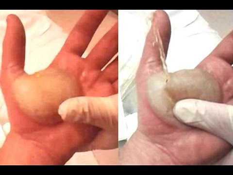 Man Pops The Biggest Blister Known To Man