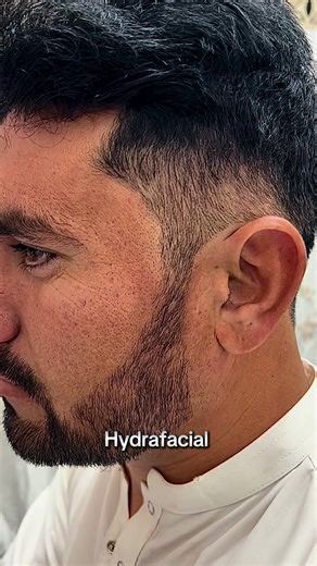 Hydrafacial Before and After Results: What to Expect