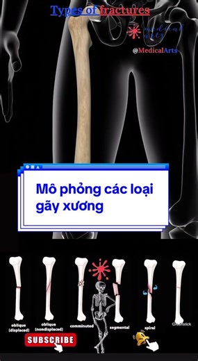 Mô phỏng các loại gãy xương trong thể thao