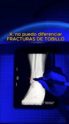 Clasificación de fracturas de tobillo‼️👀🦴🛠