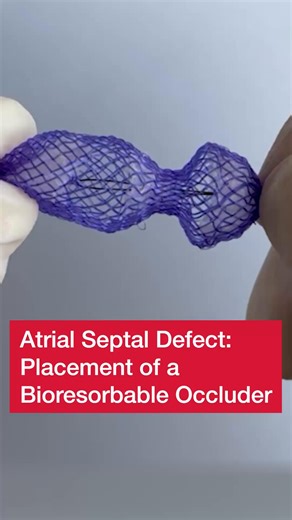 JAMA Network on Instagram: "A bioresorbable occluder offers a promising alternative to metallic devices by effectively sealing an atrial septal defect, promoting endothelialization, and gradually degrading to leave native functional tissue. 📽️ Watch the video for a demonstration of the design and implementation of a bioresorbable occlude. 📖 Read the full RCT: https://ja.ma/4i7EeXM"