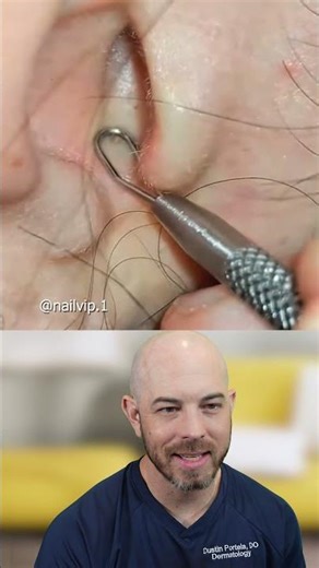 Applying Pressure for Ear Blackhead Extraction