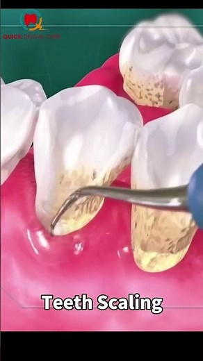 Satisfying Dental Cleaning That You Can’t Stop Watching! #foryou #explore #reels #teethscaling