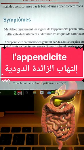 Comprendre l'appendicite aiguë : Symptômes et causes