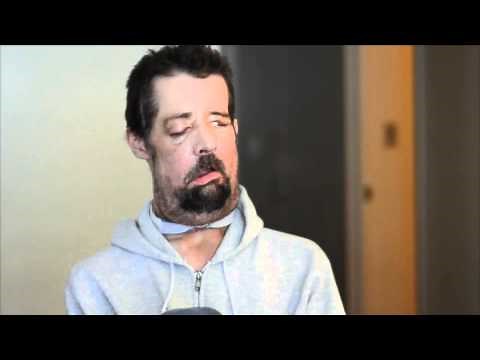 Dallas Wiens Describes First Full Face Transplant Video - Brigham and Women's Hospital