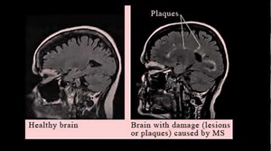 What is multiple sclerosis?