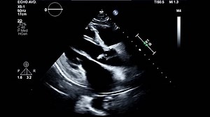 Transthoracic Echocardiogram Parasternal Long Axis View Stock Footage Video (100% Royalty-free) 3525898145 | Shutterstock