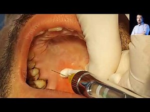 Local Anesthesia, Greater Palatine Nerve Block Technique, Maxillary anesthesia Techniques #dentistry