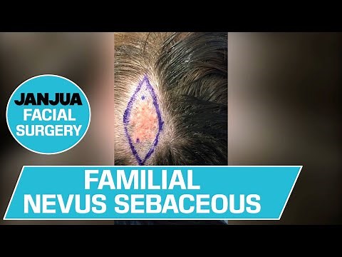 FAMILIAL NEVUS SEBACEOUS - DR. TANVEER JANJUA - NEW JERSEY
