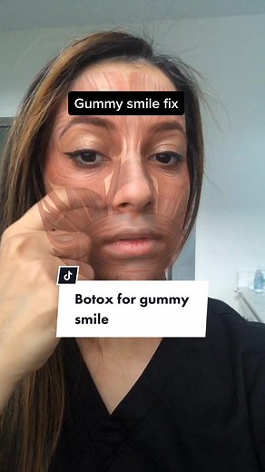 Effective Gummy Smile Treatment with Botox: Aesthetic Solutions