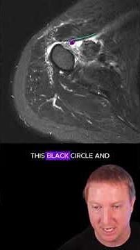 Calcific tendinosis of the pectoralis major #radiology #medicalimaging #medicalstudent #radiographer