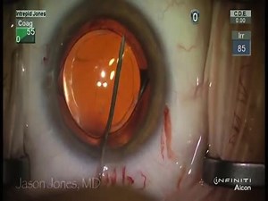 A Tale of Two Lens Exchanges - Eyetube