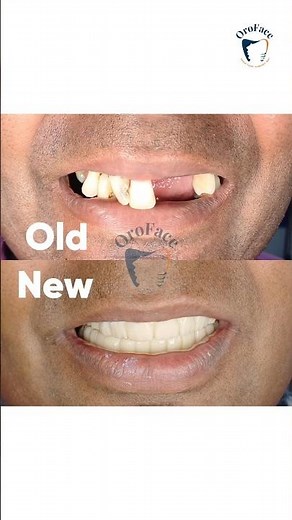 Collapsed Bite to Fixed Smile | Full Mouth Dental Implants Journey from Goa
