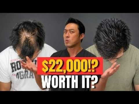 Is a $22,000 Hair Transplant Worth It? Here's the Math