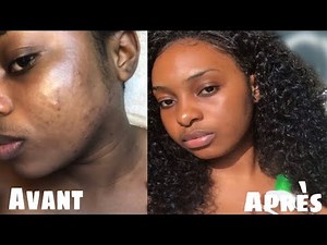 Comment j’ai sauvé ma peau: taches noires, boutons,peau terne - Ma solution || SKINCARE ROUTINE