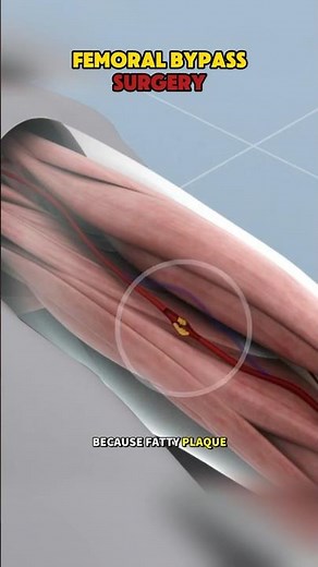 Femoral Bypass Surgery | How Blocked Leg Arteries Are Treated #shorts #shortvideo #short