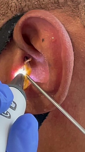 Houston Ear Wax Removal: Satisfying Earigator Extraction