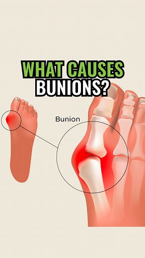 Struggling with bunions? 👣 This week is all about helping you understand what causes them and how to start resolving them. 👣 Stay tuned for some simple exercises to help you realign your toes. 👣 Want more expert guidance and support on your journey? 👣 DM us ‘I’m Ready’ to learn more! #thefootcollective #explorer #bunions #sorefeet #footpain #foothealth #restore #naturalfootwear #naturalfootfunction #strongfeet #splay #bigtoe #podiatry #freeyourfeet #community #fixyourfeet #strength #health #