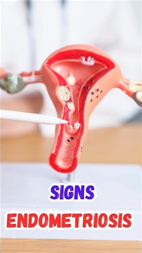 Endometriosis - Top 10 Signs #shorts #shortsfeed #health #Endometriosis