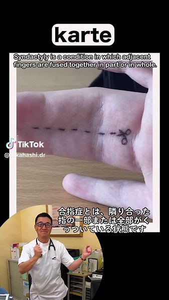 隣り合った指の一部または全部がくっついている状態の合指症について