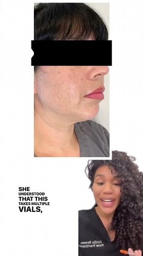 Kybella injections before and after, fat dissolving double chin, nonsurgical permanent fat removal