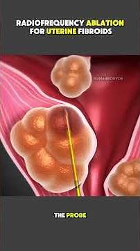 Radiofrequency Ablation for Uterine Fibroids | Procedure and Recovery #RadiofrequencyAblation
