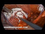 Management of Spermatic Cord Lipomas • Video • MEDtube.net