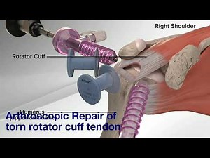 Arthroscopic Rotator Cuff Repair (Animation)