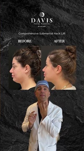 Submental Neck Lift- Surgery Approach