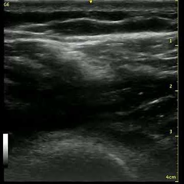 Ultrasonography of Local Twitch Response (LTR)