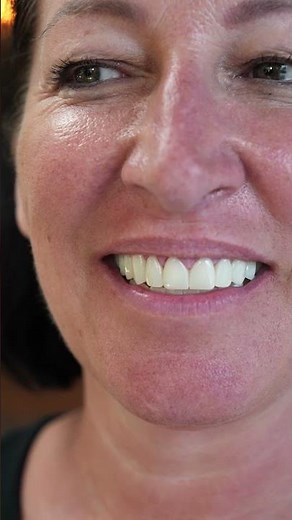 OUR DEAR PATIENT SARAH CHOSE B1 COLOR ZIRCONIUM & NATURAL STYLE DESIGN.