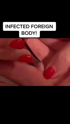 Pimple Popping | Extractions on Instagram