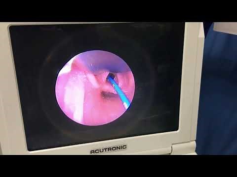 Less invasive surfactant administration LISA